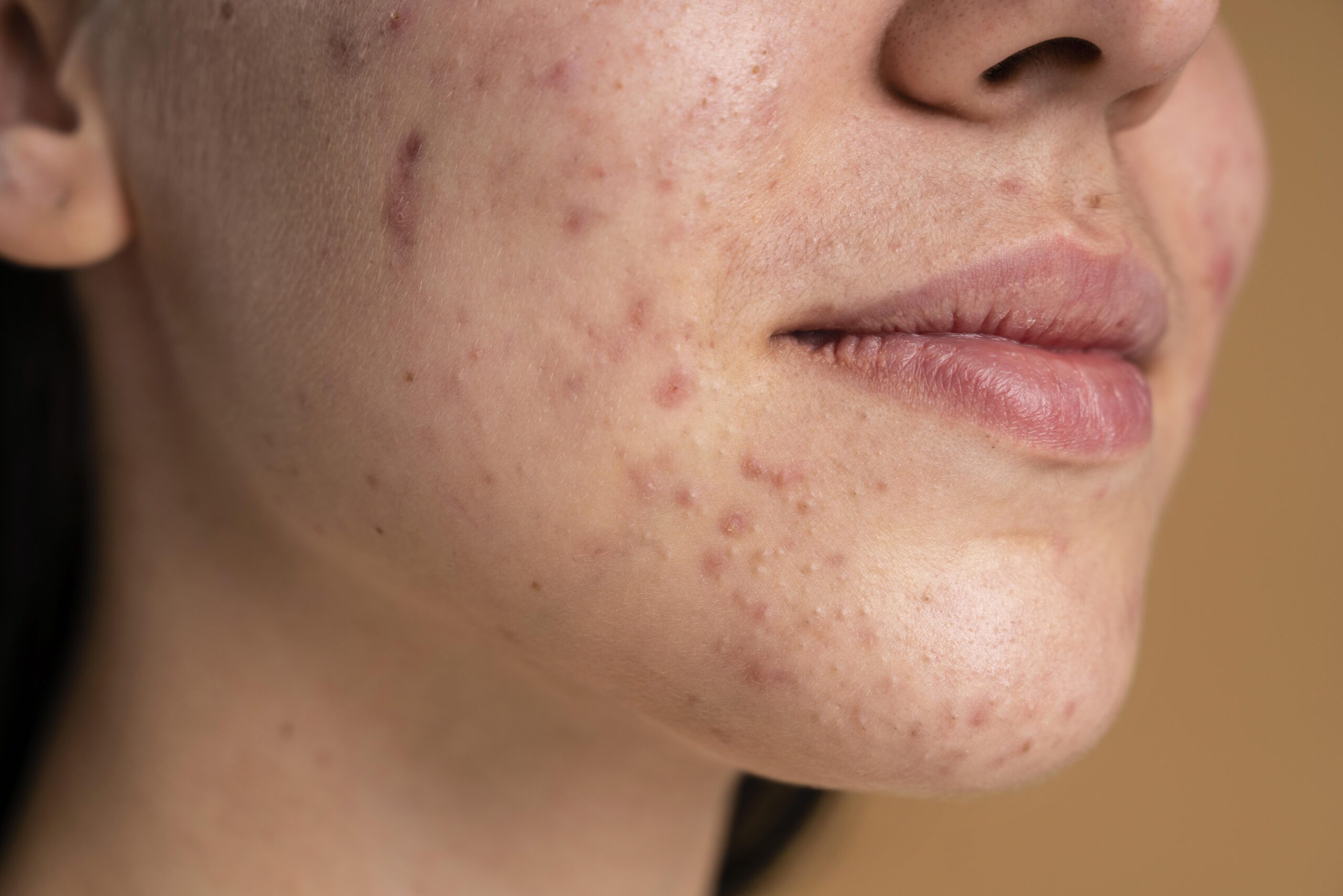 Imperfecciones en la piel